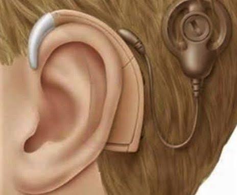 زراعة القوقعة - علاج في تونس