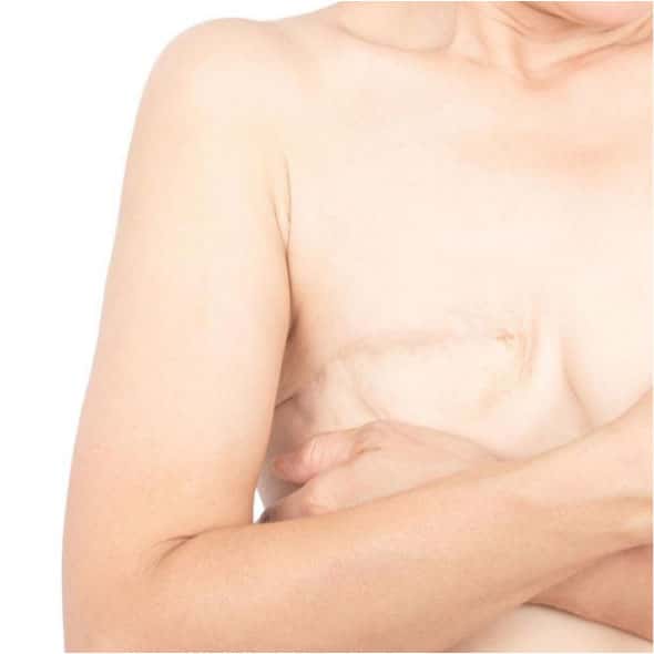 استئصال الثدي الجزئي أو الكلي في تونس بسعر رخيص
