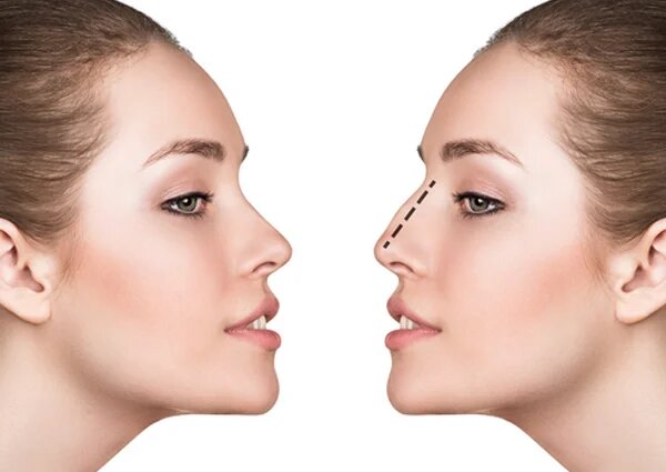 تجميل الأنف في تونس - جراحة الأنف تجميل الأنف: جراحة تجميلية للأنف في تونس